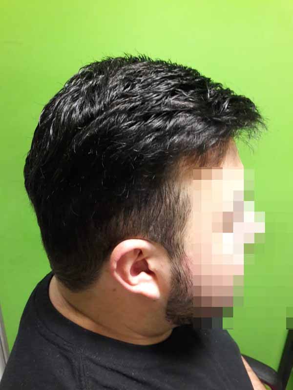 Implantes Capilares sin Cirugía
