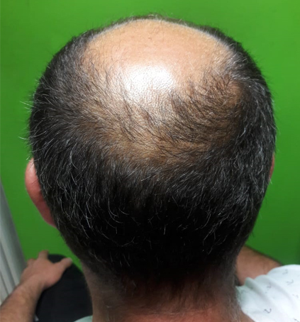 Implantes Capilares sin Cirugía