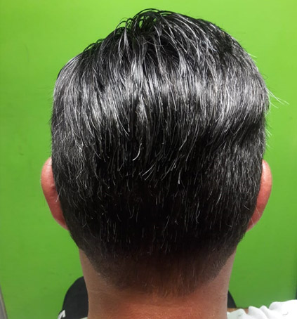 Implantes Capilares sin Cirugía