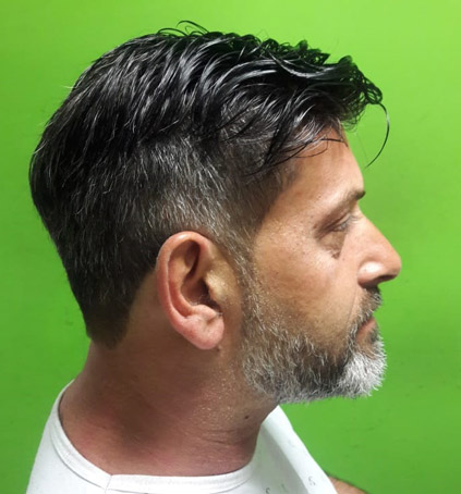 Implantes Capilares sin Cirugía
