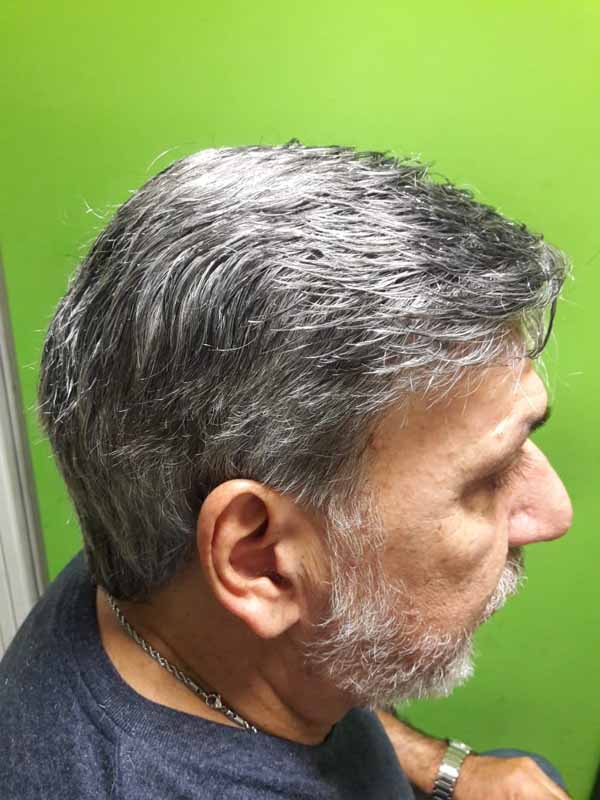 Implantes Capilares sin Cirugía