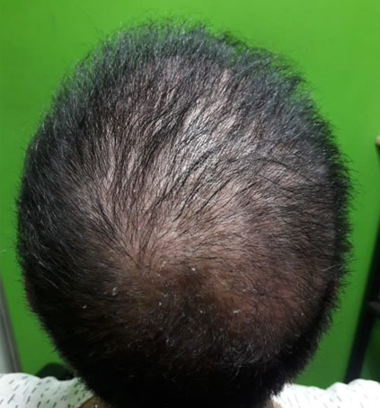Implantes Capilares sin Cirugía