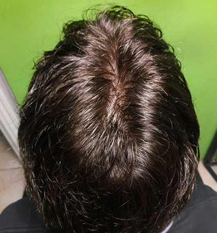 Implantes Capilares sin Cirugía