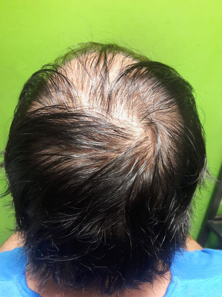 Implantes Capilares sin Cirugía